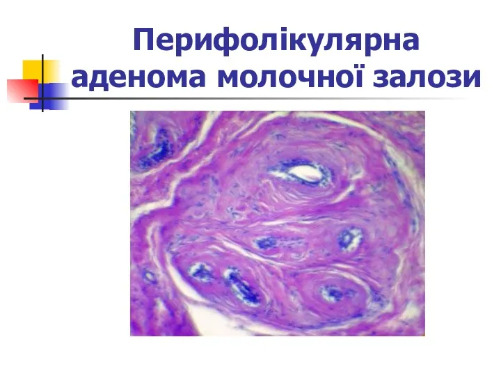 Перифолікулярна аденома молочної залози