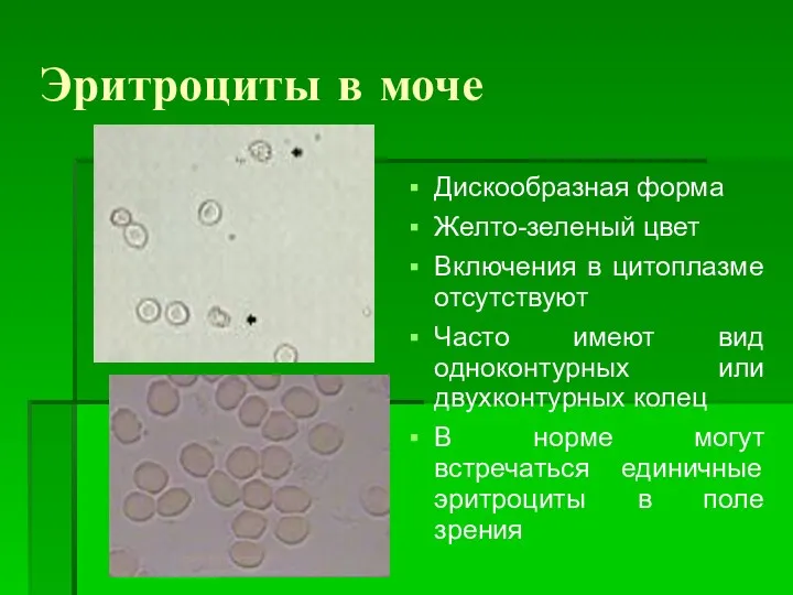 Эритроциты в моче Дискообразная форма Желто-зеленый цвет Включения в цитоплазме