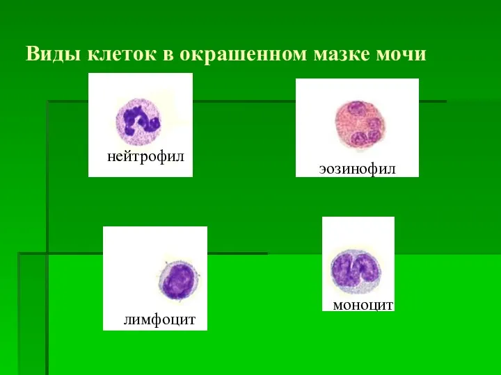 нейтрофил эозинофил моноцит лимфоцит Виды клеток в окрашенном мазке мочи