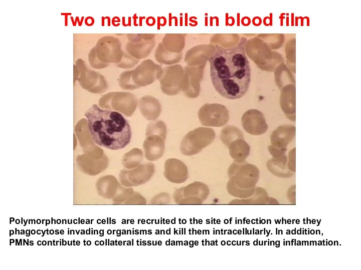 Two neutrophils in blood film Polymorphonuclear cells are recruited to