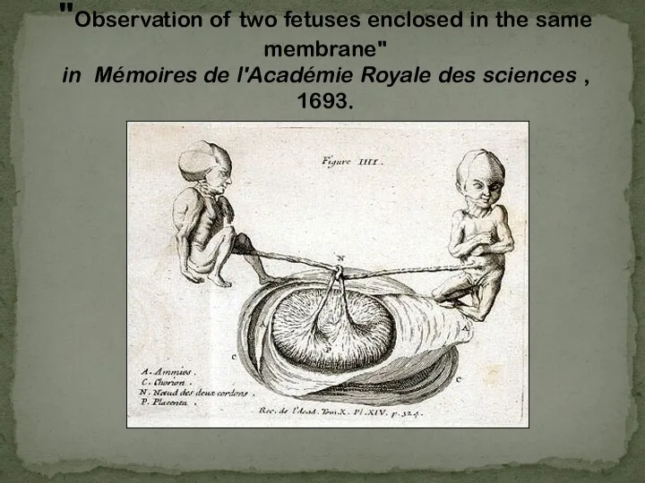 "Observation of two fetuses enclosed in the same membrane" in