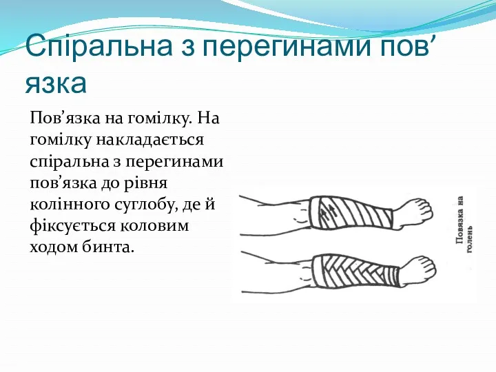 Спіральна з перегинами пов’язка Пов’язка на гомілку. На гомілку накладається