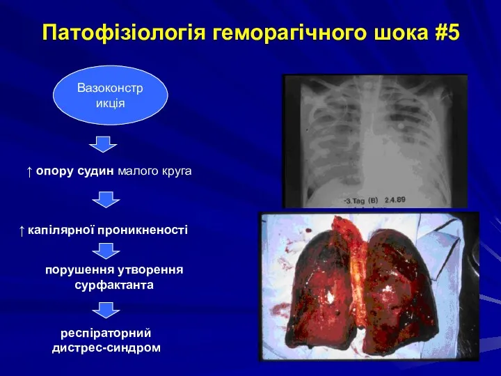 Вазоконстрикція ↑ опору судин малого круга ↑ капілярної проникненості порушення утворення сурфактанта респіраторний
