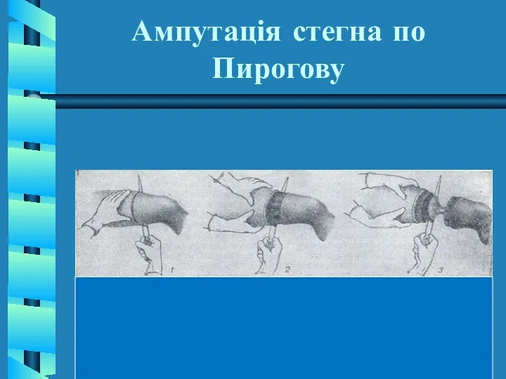 Ампутація стегна по Пирогову