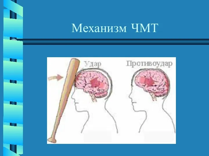 Механизм ЧМТ