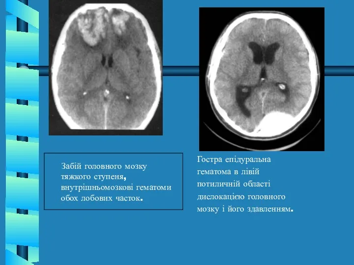 Гостра епідуральна гематома в лівій потиличній області дислокацією головного мозку і його здавленням.