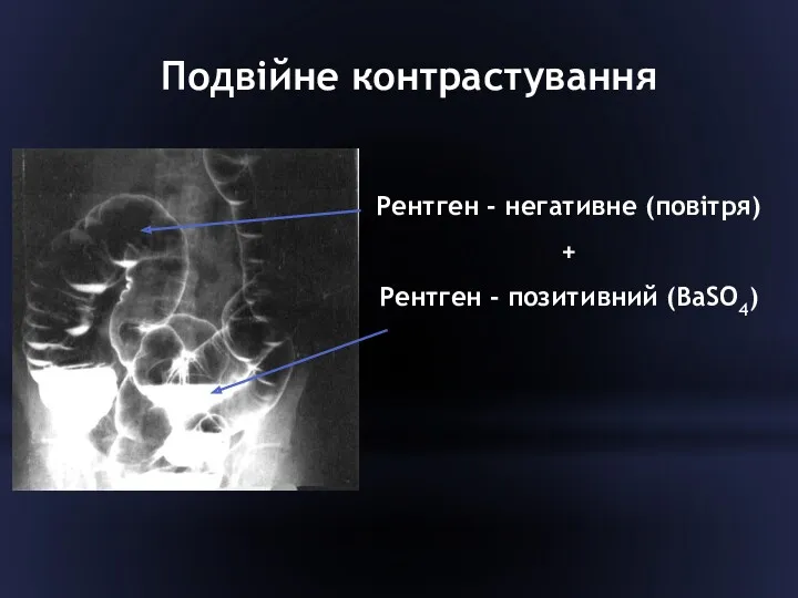 Подвійне контрастування Рентген - негативне (повітря) + Рентген - позитивний (BaSO4)