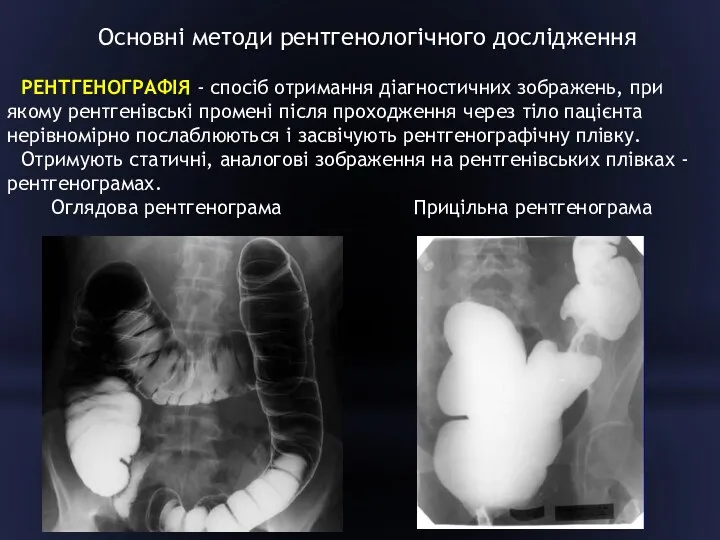 Основні методи рентгенологічного дослідження РЕНТГЕНОГРАФІЯ - спосіб отримання діагностичних зображень,