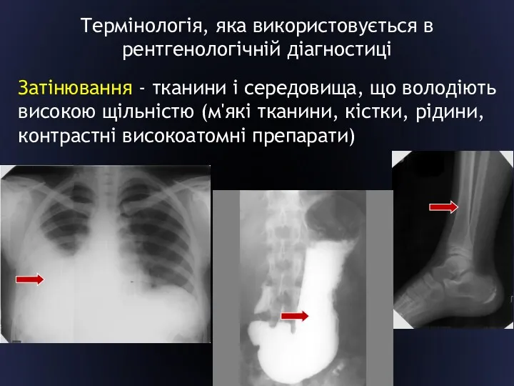 Термінологія, яка використовується в рентгенологічній діагностиці Затінювання - тканини і