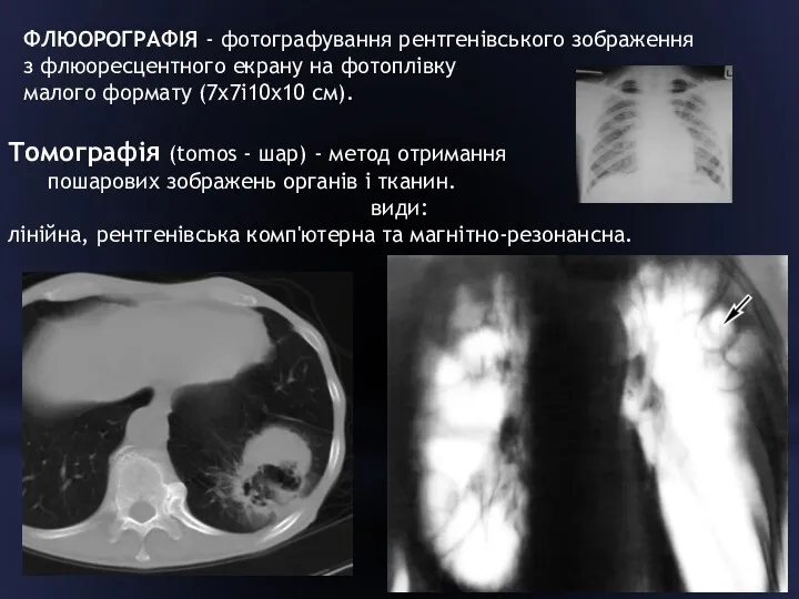 ФЛЮОРОГРАФІЯ - фотографування рентгенівського зображення з флюоресцентного екрану на фотоплівку