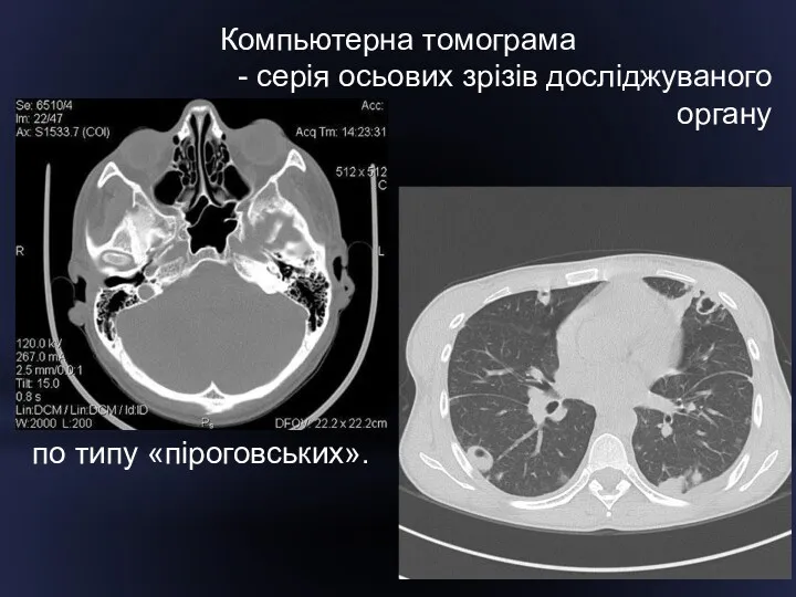 Компьютерна томограма - серія осьових зрізів досліджуваного органу по типу «піроговських».