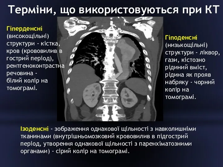 Терміни, що використовуються при КТ Гіперденсні (високощільні) структури - кістка,