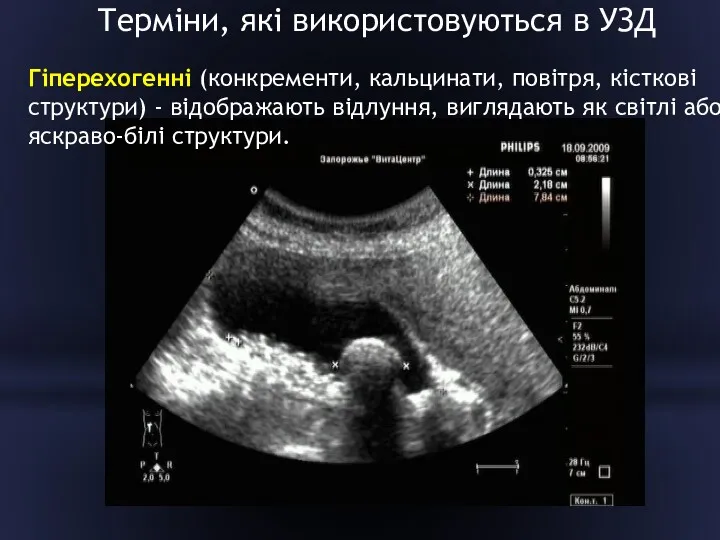 Терміни, які використовуються в УЗД Гіперехогенні (конкременти, кальцинати, повітря, кісткові