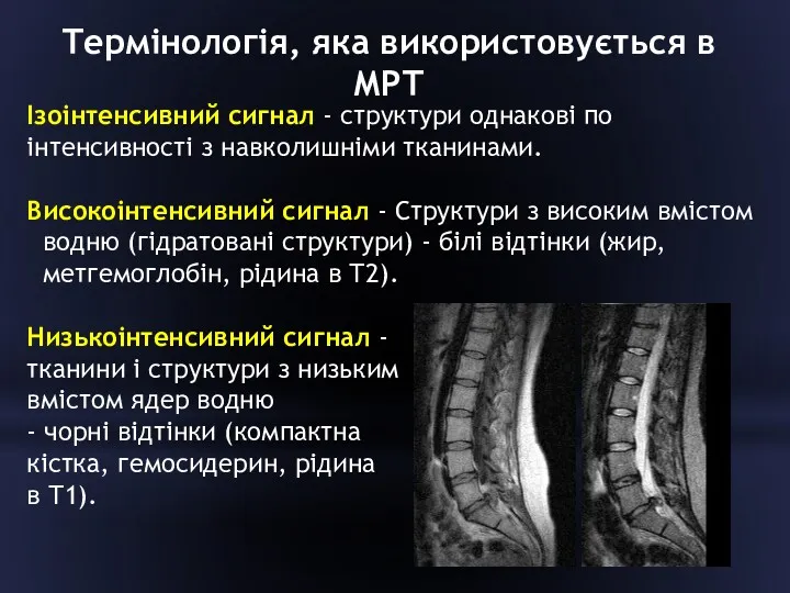 Термінологія, яка використовується в МРТ Ізоінтенсивний сигнал - структури однакові