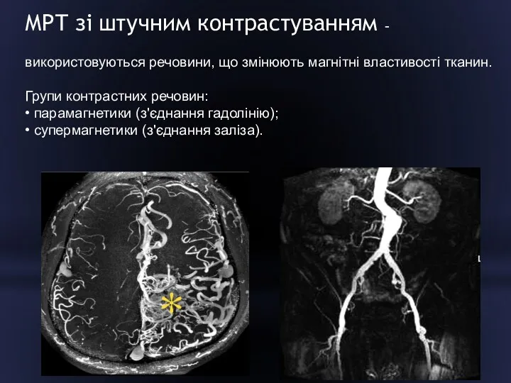 МРТ зі штучним контрастуванням - використовуються речовини, що змінюють магнітні