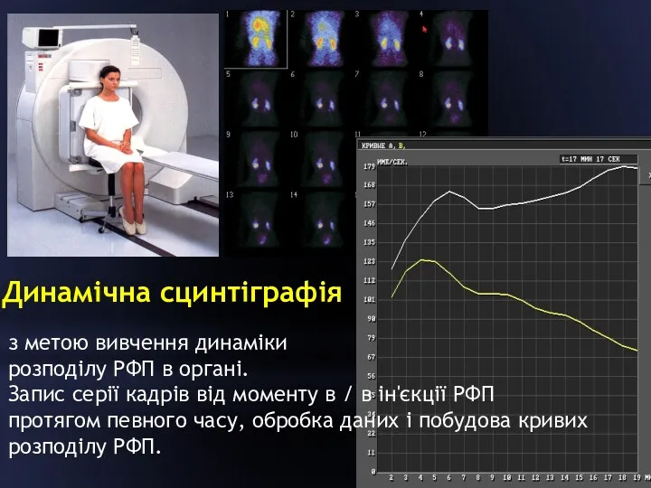 Динамічна сцинтіграфія з метою вивчення динаміки розподілу РФП в органі.