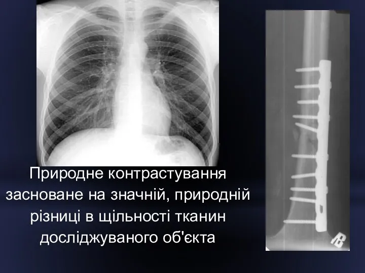 Природне контрастування засноване на значній, природній різниці в щільності тканин досліджуваного об'єкта