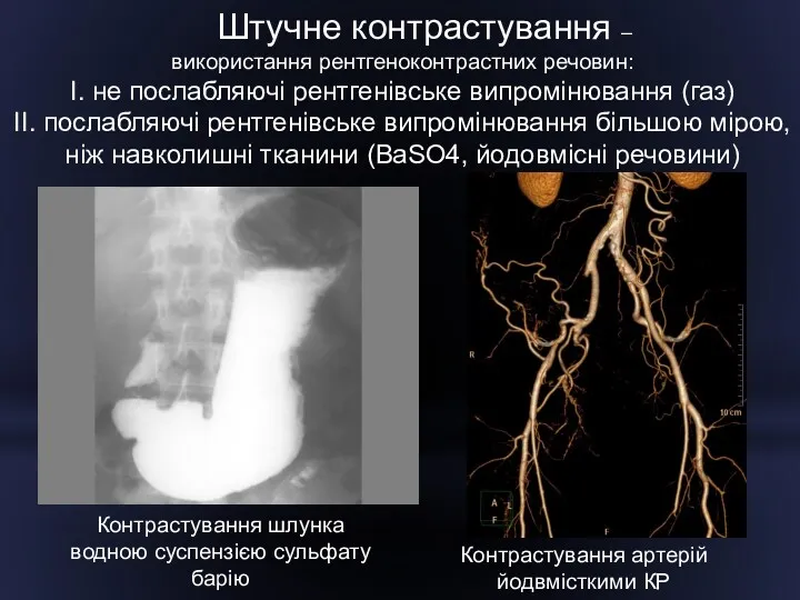 Штучне контрастування – використання рентгеноконтрастних речовин: I. не послабляючі рентгенівське