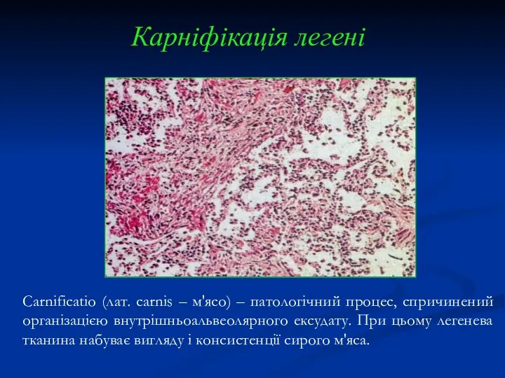 Карніфікація легені Carnificatio (лат. carnis – м'ясо) – патологічний процес,