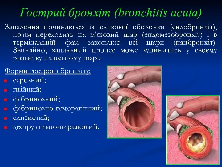 Гострий бронхіт (bronchitis acuta) Запалення починається із слизової оболонки (ендобронхіт),