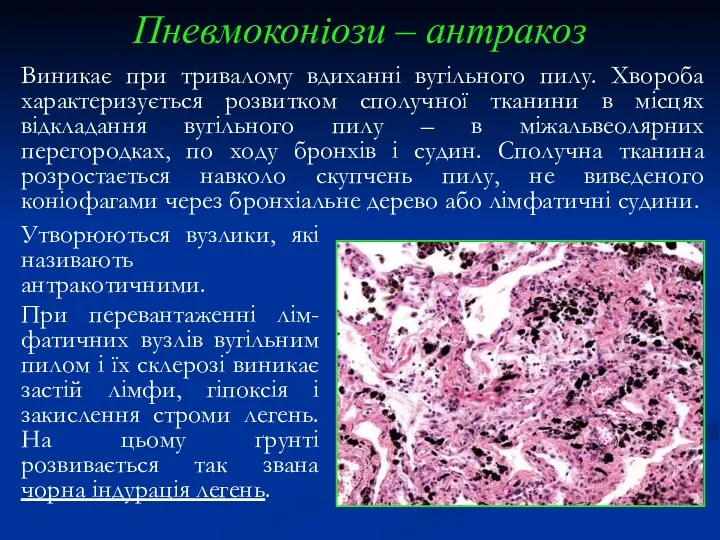 Пневмоконіози – антракоз Виникає при тривалому вдиханні вугільного пилу. Хвороба