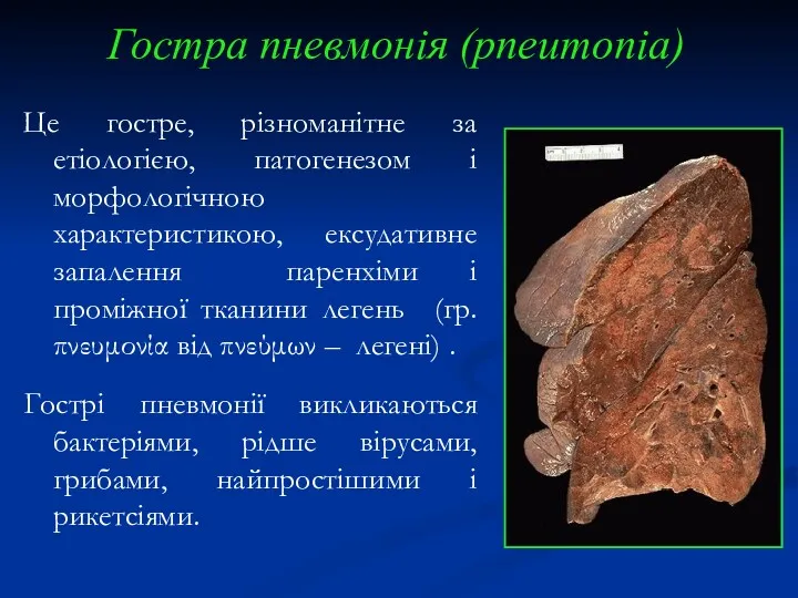 Гостра пневмонія (pneumonia) Це гостре, різноманітне за етіологією, патогенезом і