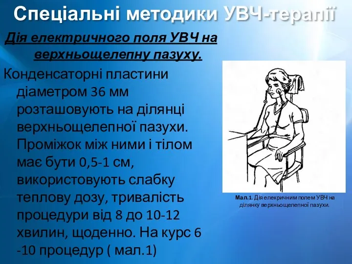 Дія електричного поля УВЧ на верхньощелепну пазуху. Конденсаторні пластини діаметром