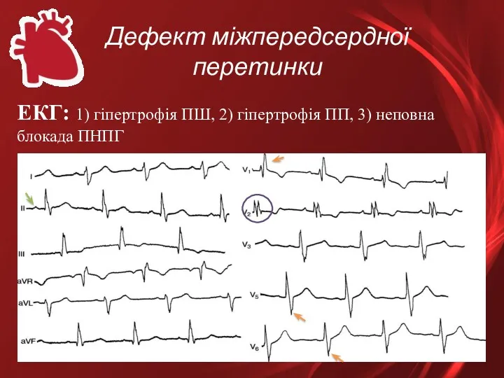 Дефект міжпередсердної перетинки ЕКГ: 1) гіпертрофія ПШ, 2) гіпертрофія ПП, 3) неповна блокада ПНПГ