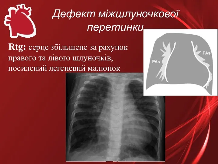 Дефект міжшлуночкової перетинки Rtg: серце збільшене за рахунок правого та лівого шлуночків, посилений легеневий малюнок