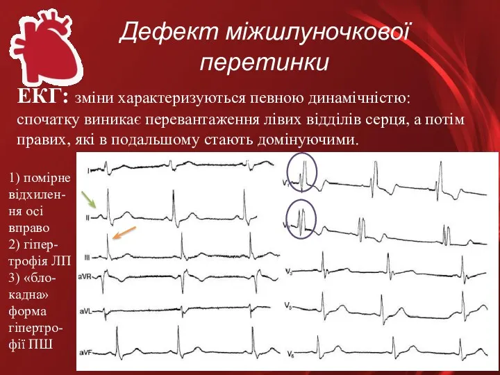 Дефект міжшлуночкової перетинки ЕКГ: зміни характеризуються певною динамічністю: спочатку виникає