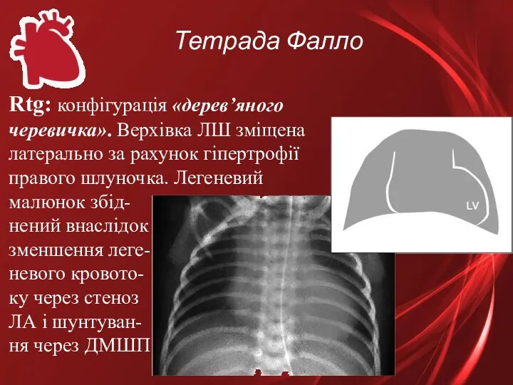 Тетрада Фалло Rtg: конфігурація «дерев’яного черевичка». Верхівка ЛШ зміщена латерально