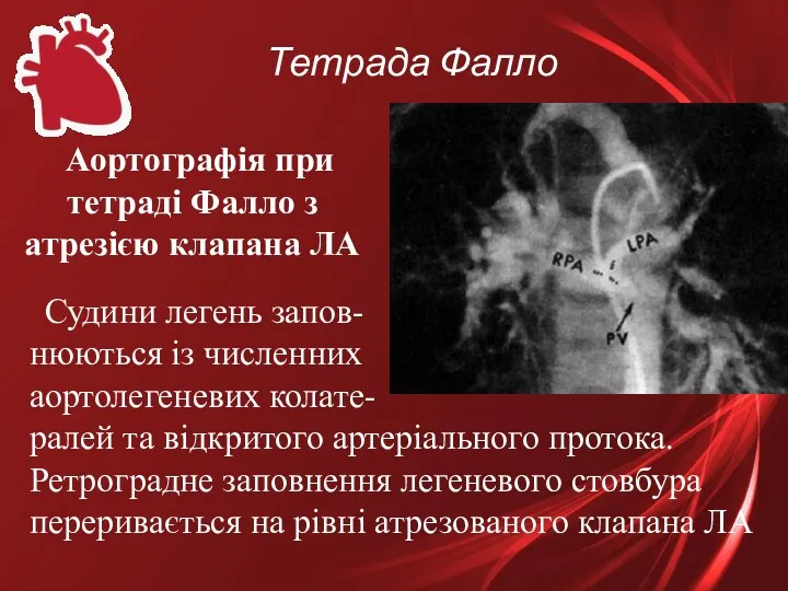 Тетрада Фалло Судини легень запов- нюються із численних аортолегеневих колате-