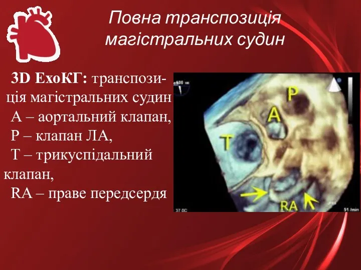 Повна транспозиція магістральних судин 3D ЕхоКГ: транспози- ція магістральних судин