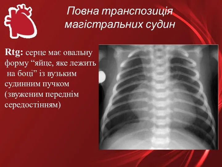 Повна транспозиція магістральних судин Rtg: серце має овальну форму “яйце,