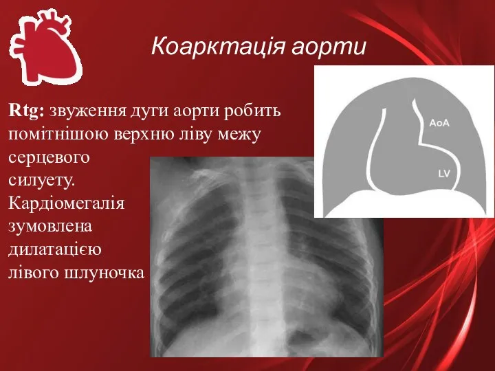 Коарктація аорти Rtg: звуження дуги аорти робить помітнішою верхню ліву