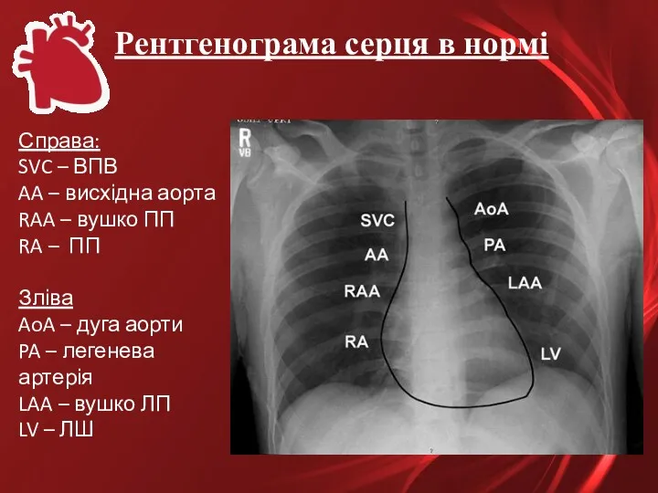 Рентгенограма серця в нормі Справа: SVC – ВПВ AA –