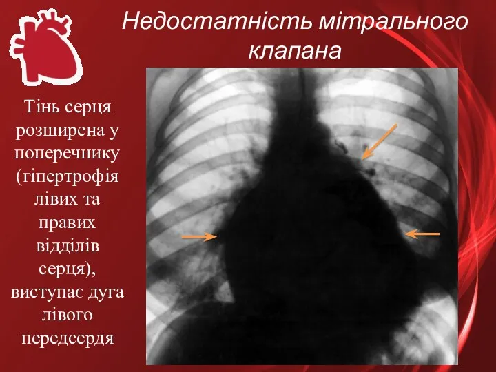 Недостатність мітрального клапана Тінь серця розширена у поперечнику (гіпертрофія лівих