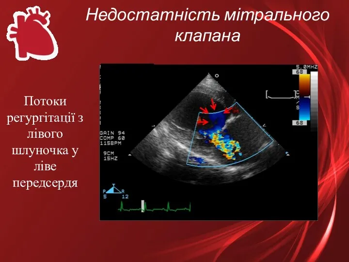 Недостатність мітрального клапана Потоки регургітації з лівого шлуночка у ліве передсердя