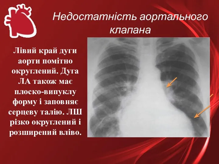 Недостатність аортального клапана Лівий край дуги аорти помітно округлений. Дуга