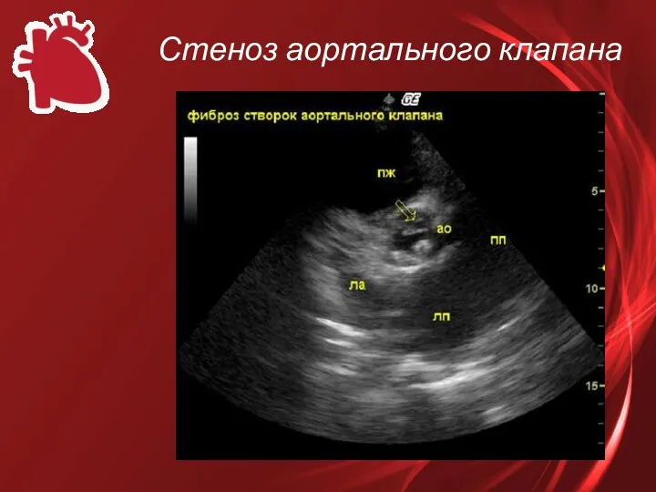 Стеноз аортального клапана