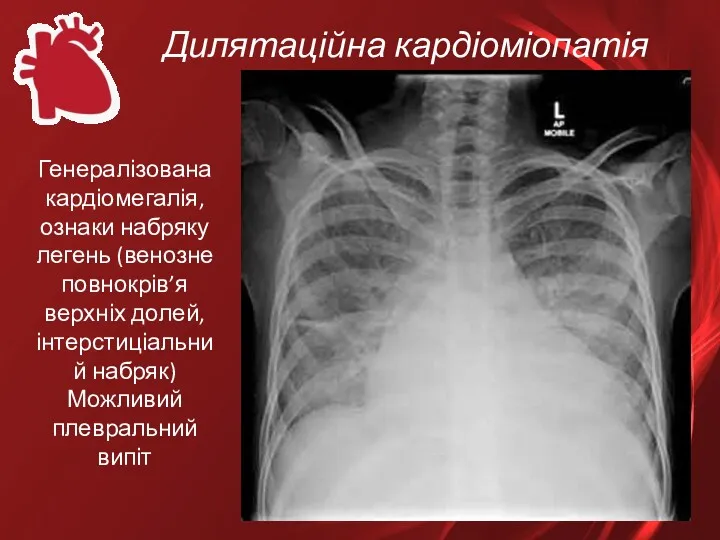 Дилятаційна кардіоміопатія Генералізована кардіомегалія, ознаки набряку легень (венозне повнокрів’я верхніх долей, інтерстиціальний набряк) Можливий плевральний випіт