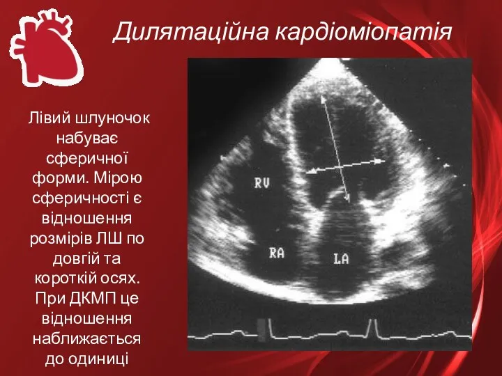 Дилятаційна кардіоміопатія Лівий шлуночок набуває сферичної форми. Мірою сферичності є