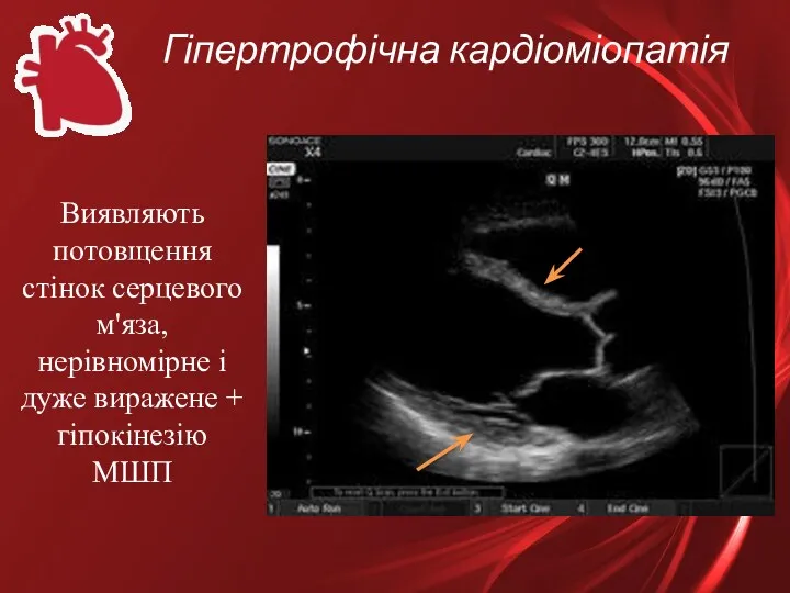 Гіпертрофічна кардіоміопатія Виявляють потовщення стінок серцевого м'яза, нерівномірне і дуже виражене + гіпокінезію МШП