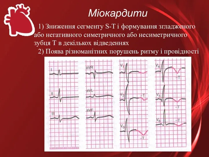 Міокардити 1) Зниження сегменту S-T і формування згладженого або негативного