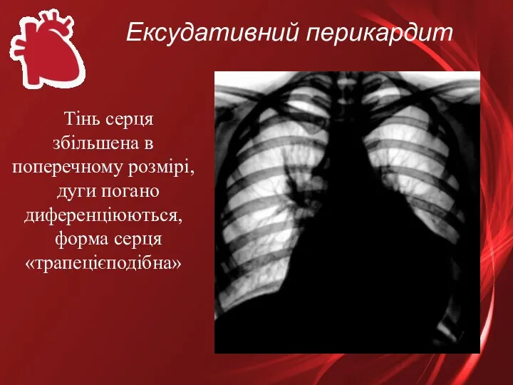 Ексудативний перикардит Тінь серця збільшена в поперечному розмірі, дуги погано диференціюються, форма серця «трапецієподібна»