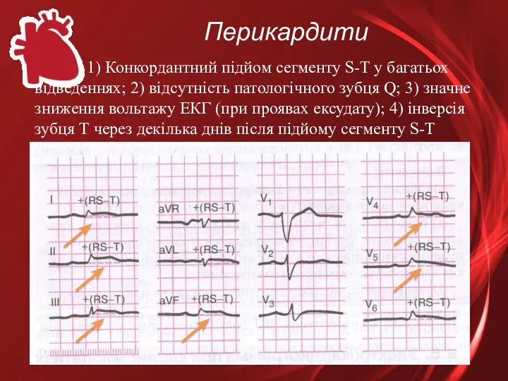 Перикардити 1) Конкордантний підйом сегменту S-T у багатьох відведеннях; 2)