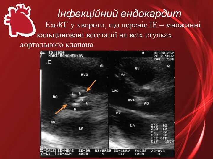 Інфекційний ендокардит ЕхоКГ у хворого, що переніс ІЕ – множинні