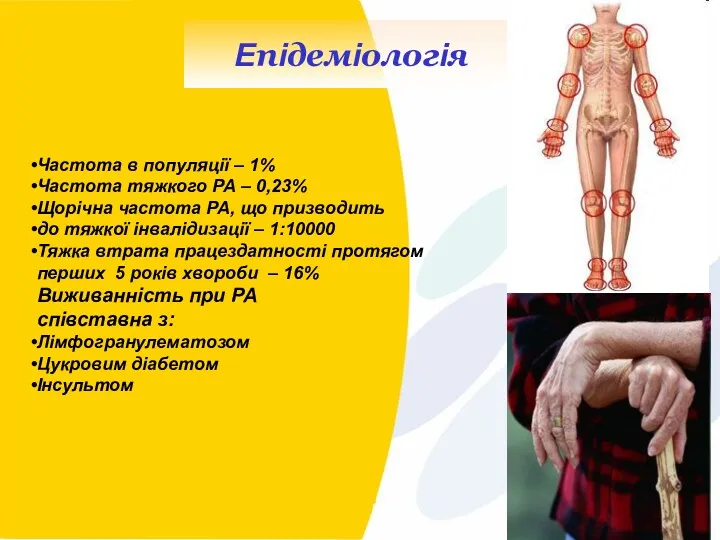 Orion Corporation Lyudmyla Berenok Епідеміологія Частота в популяції – 1%