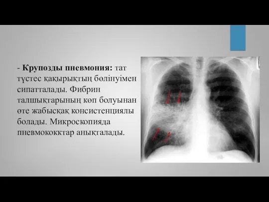 - Крупозды пневмония: тат түстес қақырықтың бөлінуімен сипатталады. Фибрин талшықтарының