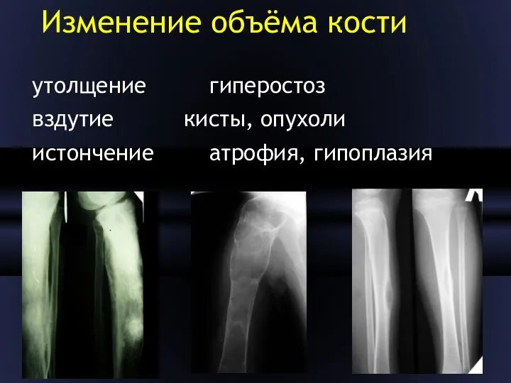 Изменение объёма кости утолщение гиперостоз вздутие кисты, опухоли истончение атрофия, гипоплазия